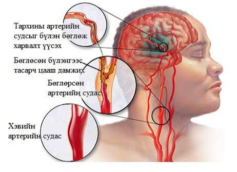 Харвалт бол ХӨГШИН ХҮНИЙ ӨВЧИН БИШ